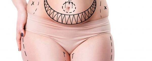 liposuccion